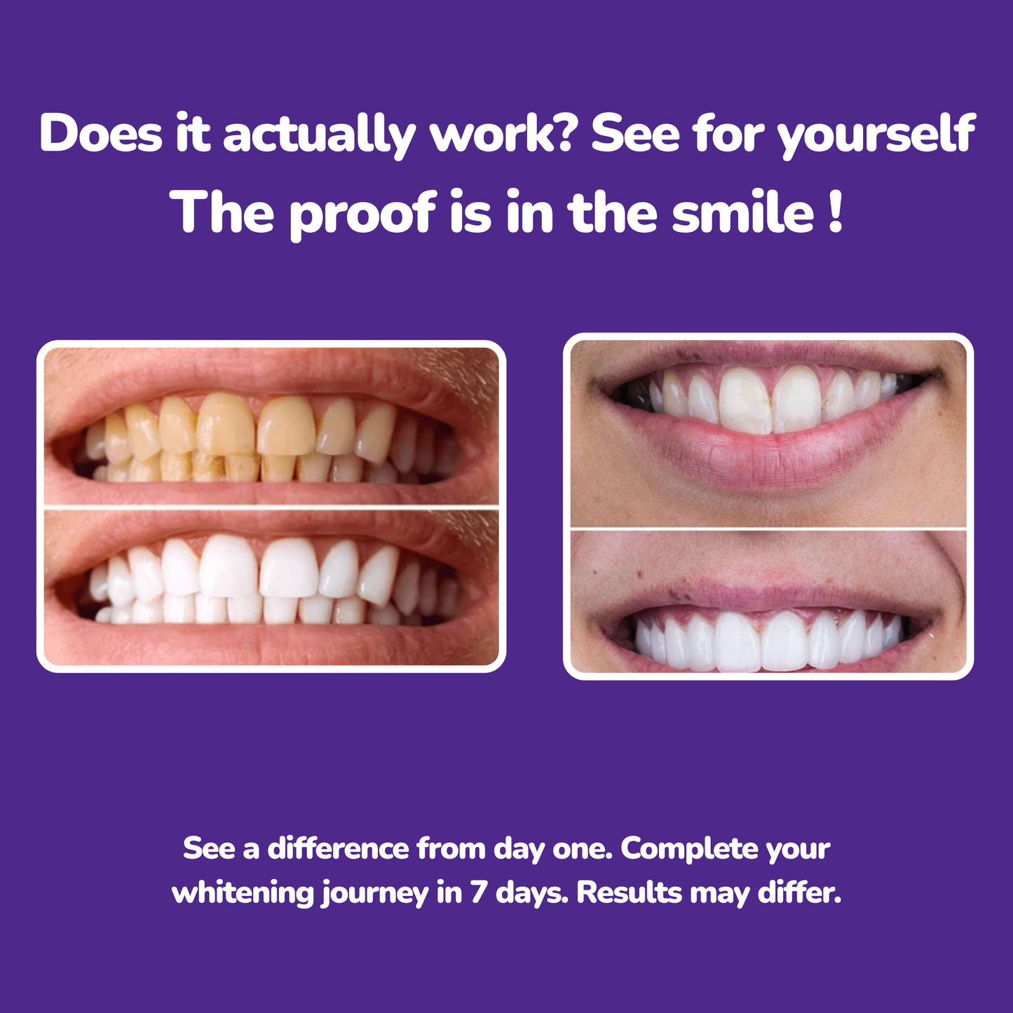 PureWhite™ – A Perfect Smile In Less Than 30 Minutes